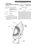 Prosthesis Implantation Method diagram and image