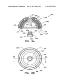 Prosthesis Implantation Method diagram and image