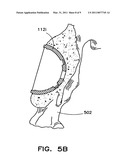 Prosthesis Implantation Method diagram and image