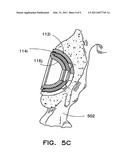 Prosthesis Implantation Method diagram and image