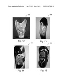 Systems and Methods for Personalizing Prosthetic and Orthotic Devices diagram and image