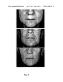 METHODS FOR MEASURING CHANGE IN LIP SIZE AFTER AUGMENTATION diagram and image