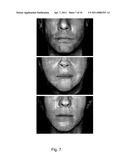 METHODS FOR MEASURING CHANGE IN LIP SIZE AFTER AUGMENTATION diagram and image