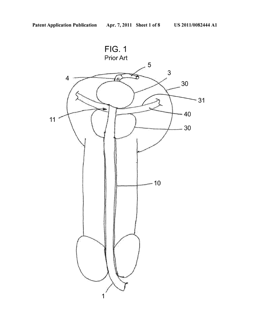 Zero-Pressure Balloon Catheter and Method for Using the Catheter - diagram, schematic, and image 02