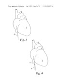 CARDIAC ABLATION SYSTEM WITH AUTOMATIC SAFETY SHUT-OFF FEATURE diagram and image