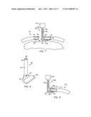 METHODS AND DEVICES FOR STERNAL CLOSURE diagram and image