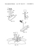 METHODS AND DEVICES FOR STERNAL CLOSURE diagram and image