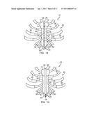 METHODS AND DEVICES FOR STERNAL CLOSURE diagram and image