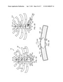 METHODS AND DEVICES FOR STERNAL CLOSURE diagram and image