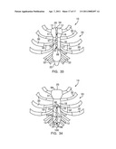 METHODS AND DEVICES FOR STERNAL CLOSURE diagram and image