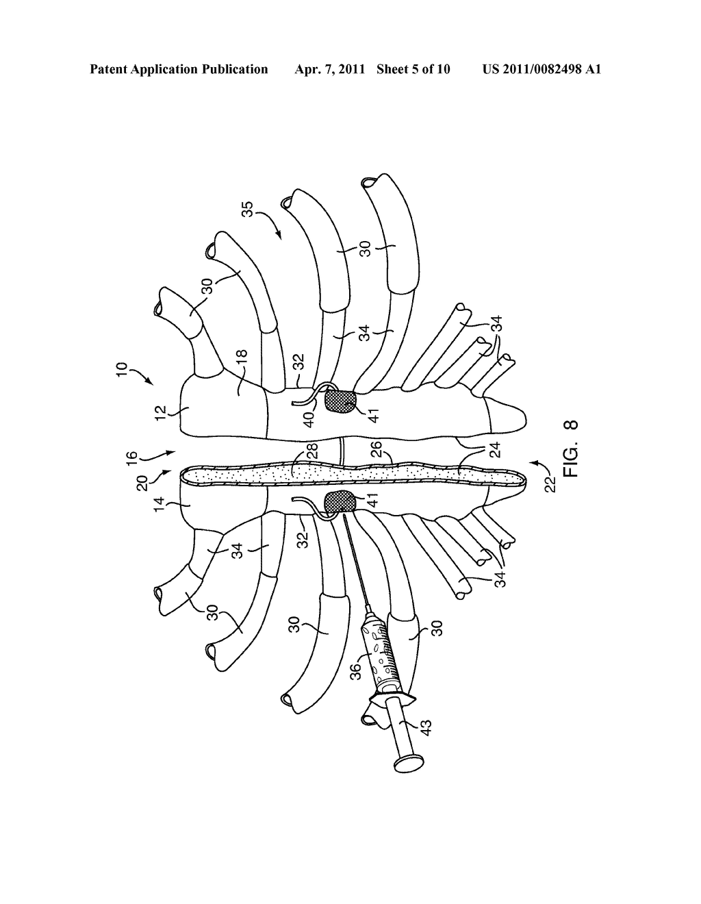 METHODS FOR STERNAL CLOSURE - diagram, schematic, and image 06