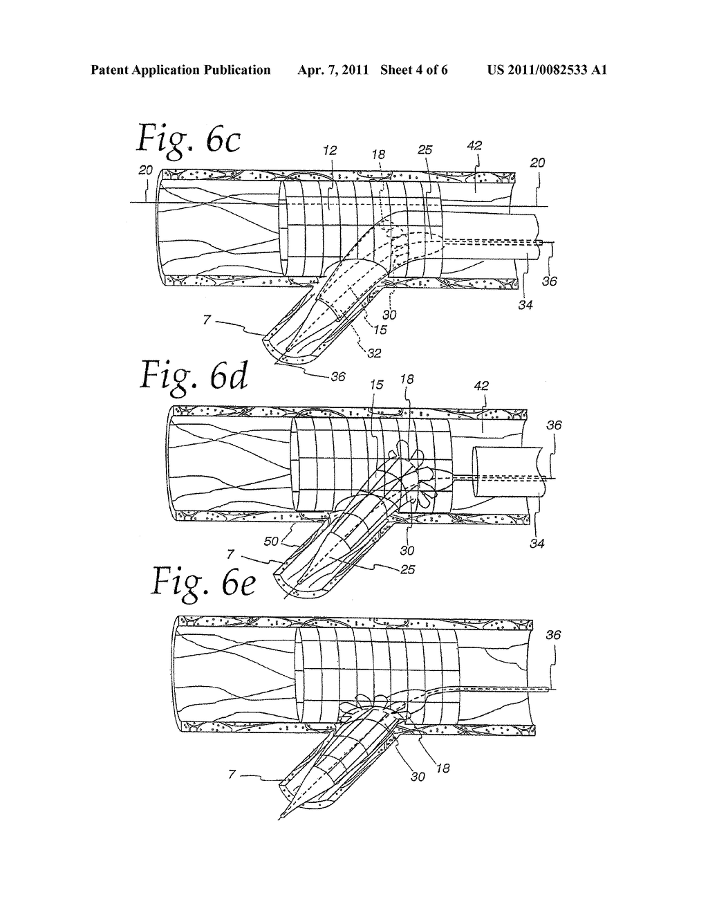 Extendible Stent Apparatus - diagram, schematic, and image 05