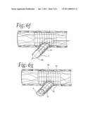 Extendible Stent Apparatus diagram and image