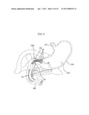 BALLOON TYPE STENT SYSTEM FOR TREATMENT OF OBESITY diagram and image