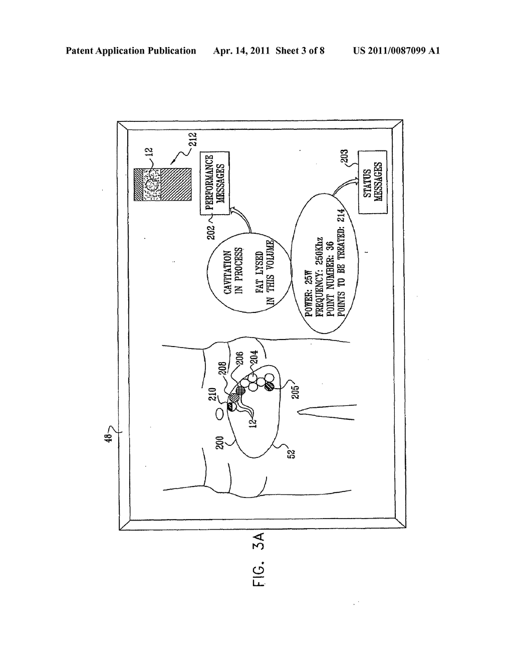 NON-INVASIVE ULTRASONIC BODY CONTOURING - diagram, schematic, and image 04