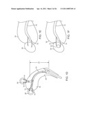 METHOD AND DEVICE FOR UTERINE FIBROID TREATMENT diagram and image