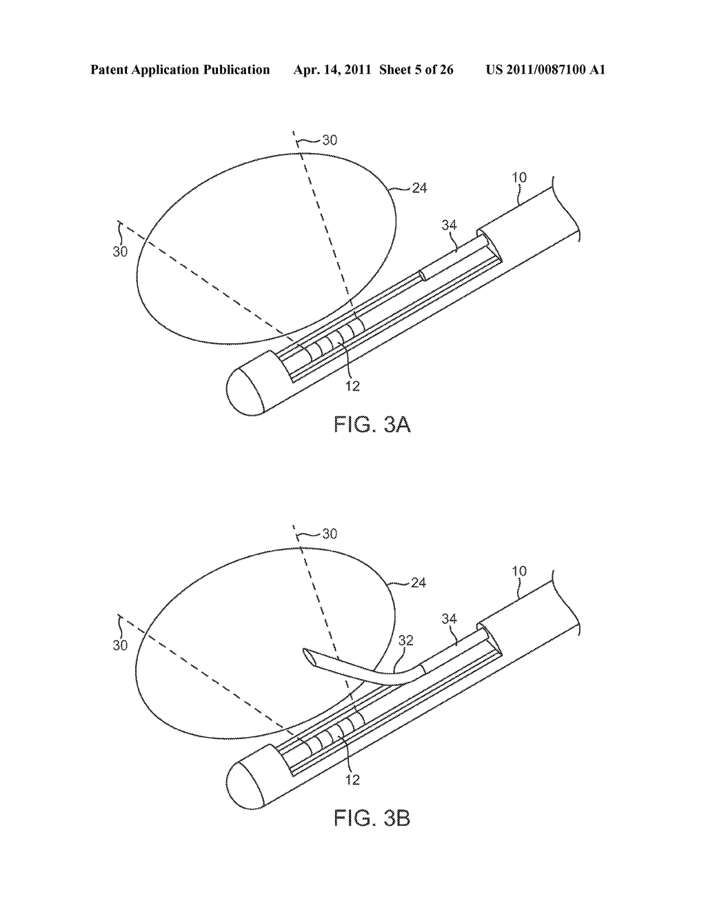 METHOD AND DEVICE FOR UTERINE FIBROID TREATMENT - diagram, schematic, and image 06