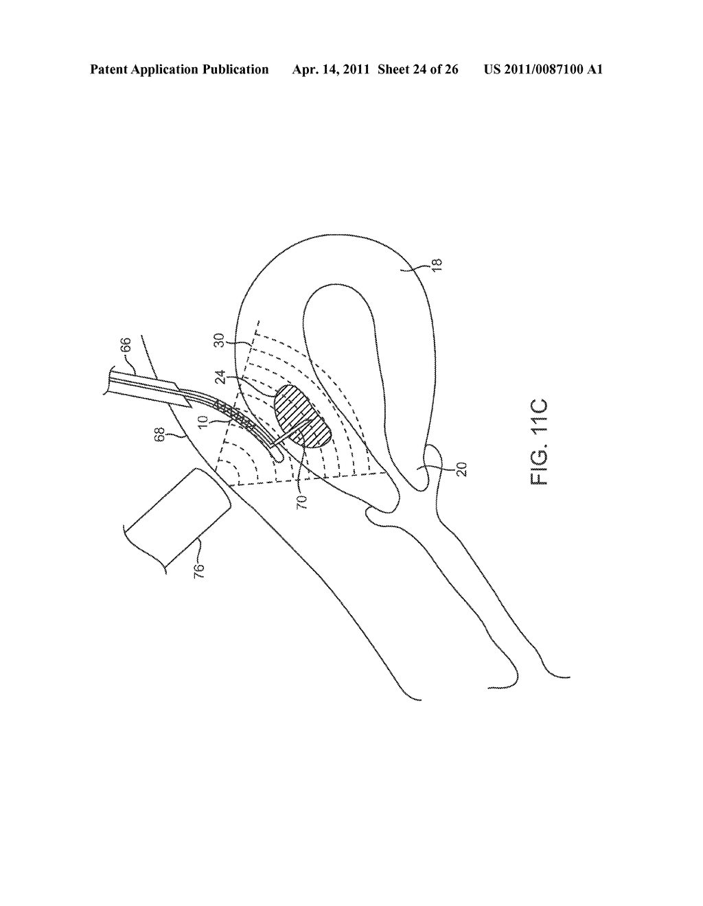 METHOD AND DEVICE FOR UTERINE FIBROID TREATMENT - diagram, schematic, and image 25