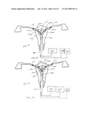 METHODS AND APPARATUS FOR DETERMINING FALLOPIAN TUBE OCCLUSION diagram and image