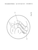 EXTENDABLE SPECIMEN COLLECTING DEVICE diagram and image