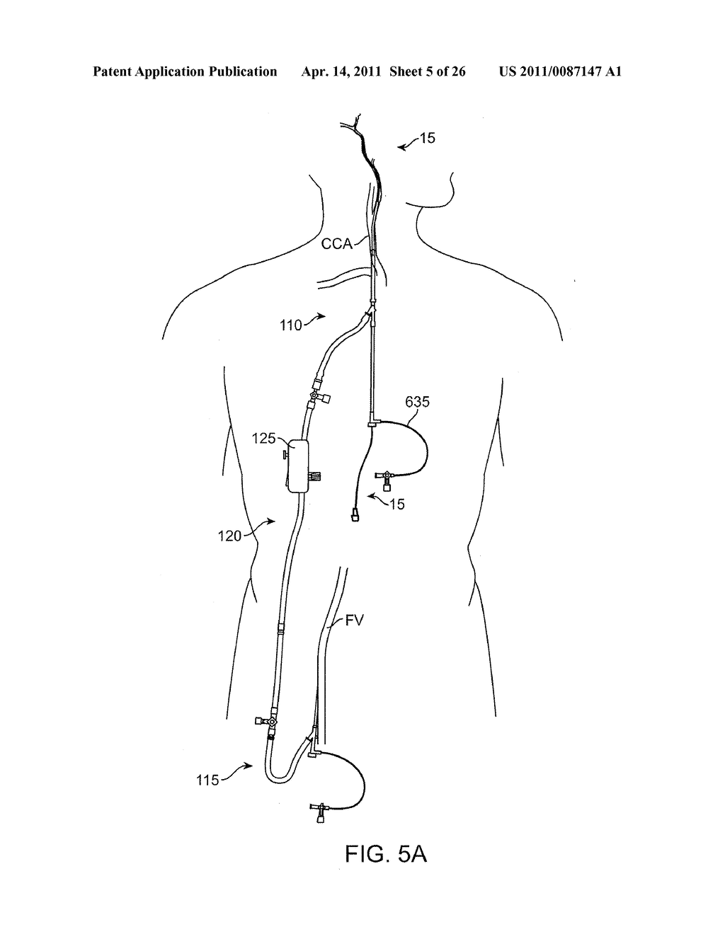 METHODS AND SYSTEMS FOR TREATMENT OF ACUTE ISCHEMIC STROKE - diagram, schematic, and image 06