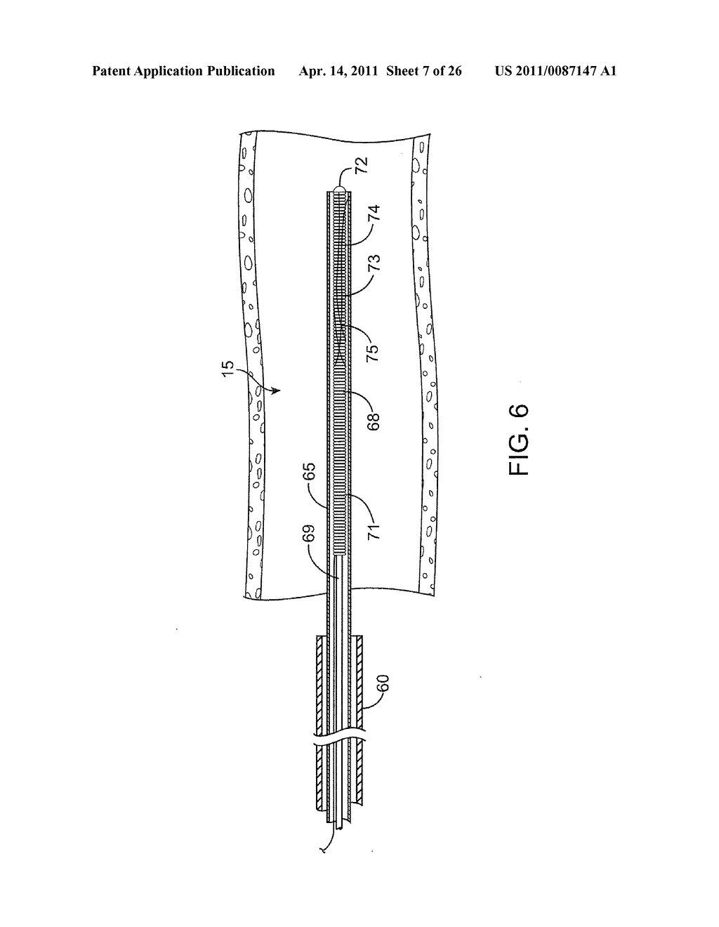 METHODS AND SYSTEMS FOR TREATMENT OF ACUTE ISCHEMIC STROKE - diagram, schematic, and image 08