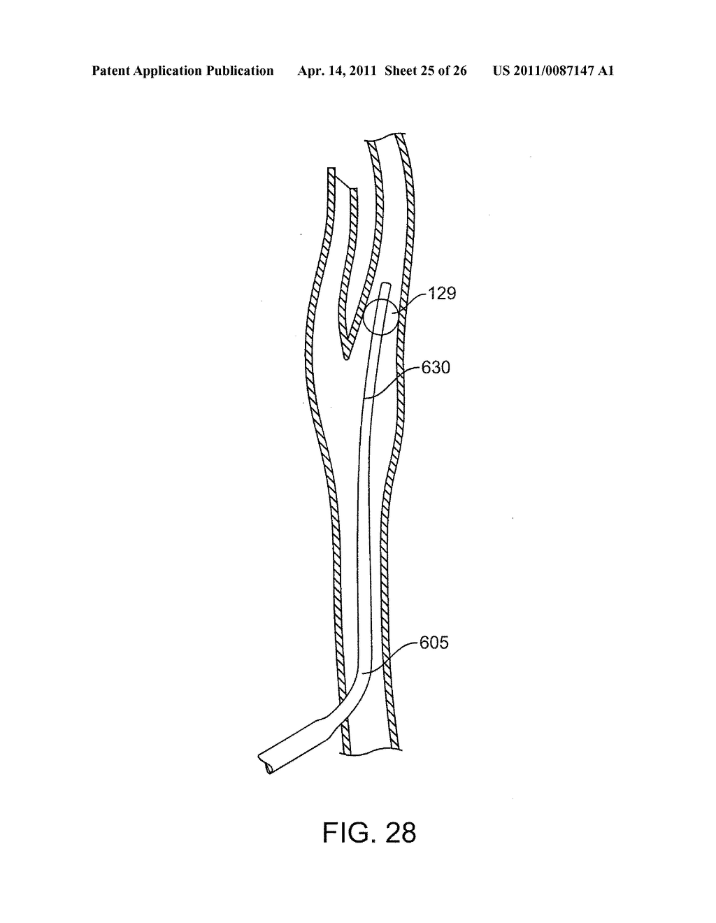 METHODS AND SYSTEMS FOR TREATMENT OF ACUTE ISCHEMIC STROKE - diagram, schematic, and image 26