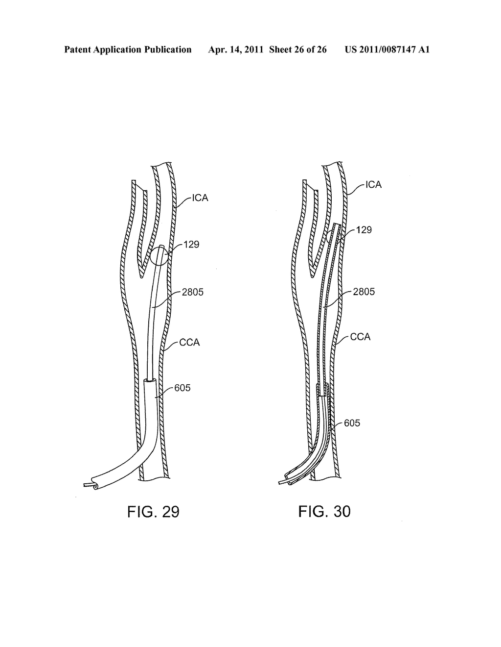 METHODS AND SYSTEMS FOR TREATMENT OF ACUTE ISCHEMIC STROKE - diagram, schematic, and image 27