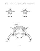 OCULAR IMPLANT WITH STIFFNESS QUALITIES, METHODS OF IMPLANTATION AND SYSTEM diagram and image