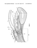 OCULAR IMPLANT WITH STIFFNESS QUALITIES, METHODS OF IMPLANTATION AND SYSTEM diagram and image