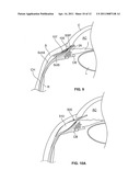 OCULAR IMPLANT WITH STIFFNESS QUALITIES, METHODS OF IMPLANTATION AND SYSTEM diagram and image