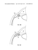 OCULAR IMPLANT WITH STIFFNESS QUALITIES, METHODS OF IMPLANTATION AND SYSTEM diagram and image