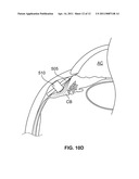 OCULAR IMPLANT WITH STIFFNESS QUALITIES, METHODS OF IMPLANTATION AND SYSTEM diagram and image