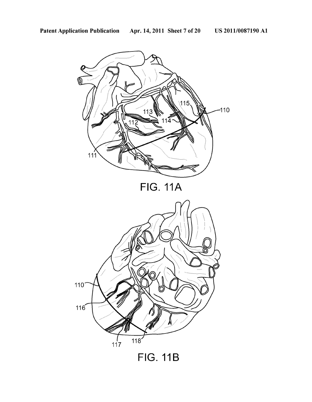 Cardiac Repair, Resizing and Reshaping Using the Venous System of the Heart - diagram, schematic, and image 08