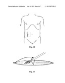 MULTIFUNCTION CARBASUS FOR LAPAROSCOPIC OPERATION diagram and image