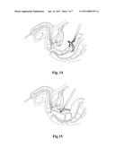 MULTIFUNCTION CARBASUS FOR LAPAROSCOPIC OPERATION diagram and image