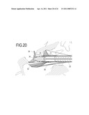 SEALING HOLES IN BONY CRANIAL ANATOMY USING CUSTOM FABRICATED INSERTS diagram and image