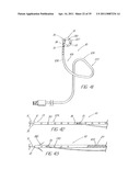 SYSTEM AND METHOD FOR INTRODUCING MULTIPLE MEDICAL DEVICES diagram and image