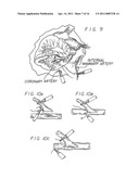 METHOD AND APPARATUS FOR PERFORMING MINIMALLY INVASIVE CARDIAC PROCEDURES diagram and image