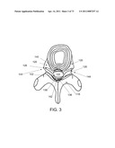 MINIMALLY INVASIVE DISCECTOMY diagram and image