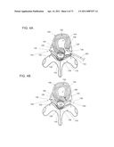 MINIMALLY INVASIVE DISCECTOMY diagram and image