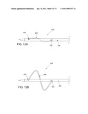 MINIMALLY INVASIVE DISCECTOMY diagram and image