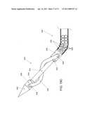 MINIMALLY INVASIVE DISCECTOMY diagram and image