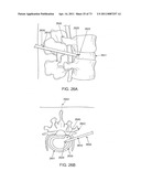 MINIMALLY INVASIVE DISCECTOMY diagram and image