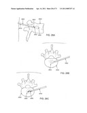 MINIMALLY INVASIVE DISCECTOMY diagram and image