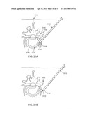 MINIMALLY INVASIVE DISCECTOMY diagram and image