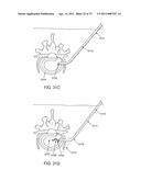 MINIMALLY INVASIVE DISCECTOMY diagram and image