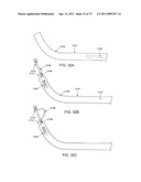 MINIMALLY INVASIVE DISCECTOMY diagram and image