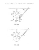 MINIMALLY INVASIVE DISCECTOMY diagram and image