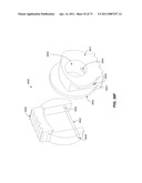 MINIMALLY INVASIVE DISCECTOMY diagram and image